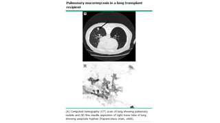 Fungal Infections in the Intensive Care Unit and Antifungals | PDF