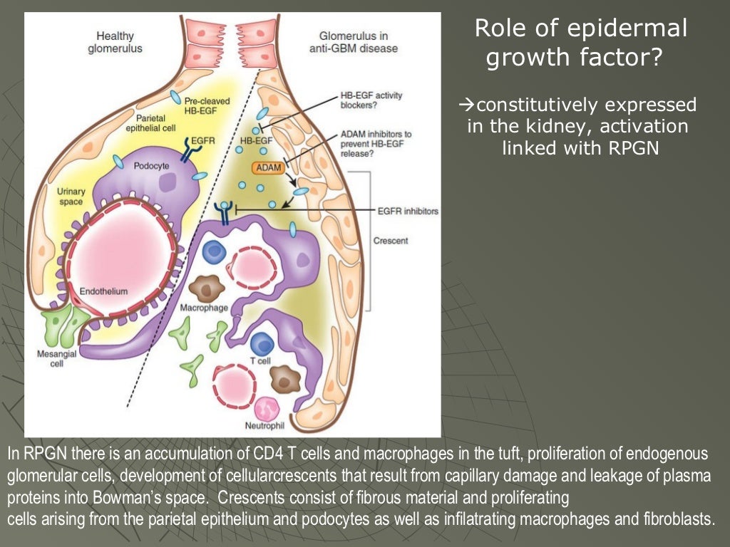 Anti-GBM Diseases