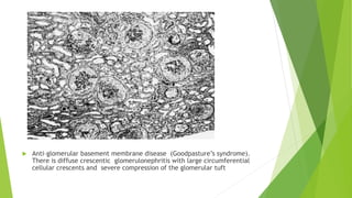 Anti gbm disease | PPTX