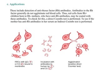 c. Applications
These include detection of anti-rhesus factor (Rh) antibodies. Antibodies to the Rh
factor generally do not agglutinate red blood cells. Thus, red cells from Rh+
children born to Rh- mothers, who have anti-Rh antibodies, may be coated with
these antibodies. To check for this, a direct Coombs test is performed. To see if the
mother has anti-Rh antibodies in her serum an Indirect Coombs test is performed.
 