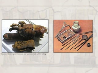 This wood and leather prosthetic toe was used by an amputee to facilitate walking
 