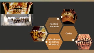 Infecciones 
dentarias 
(Gusanos) 
Caries 
Pérdida 
dentarias 
 