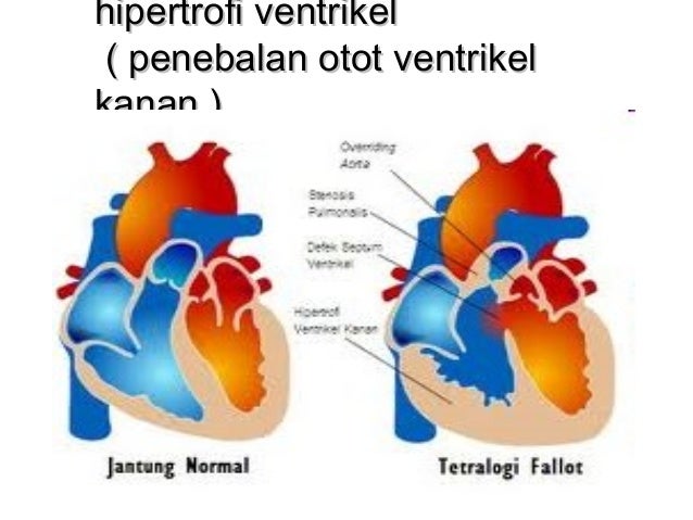 1 Bab I Pendahuluan A Latar Belakang Kasus Hipertensi