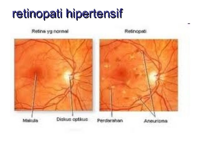 5 Langkah Sederhana Buat Tangkal  Kelola Hipertensi Health