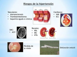 Riesgos de la hipertensión
Vasculares:
• Ateroesclerosis
• Tromboembolismos
• Isquemia aguda o crónica
Cardiacos:
• IAM
• ICC
SNC:
• ACV
Renales:
• IRA
• IRC
• HTA
Pérdida de
la visión Disfunción eréctil
 