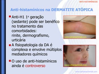 ANTI-HISTAMÍNICOS
www.adrianaschmidt.com
www.adrianaschmidt.com
www.adrianaschmidt.com
Anti-histamínicos na DERMATITE ATÓPICA
A fisiopatologia da DA é
complexa e envolve múltiplos
mediadores químicos
O uso de anti-histamínicos
ainda é controverso
Anti-H1 1a
geração
(sedante) pode ser benéfico
no tratamento das
comorbidades:
rinite, dermografismo,
urticária
 