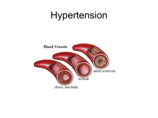 Hypertension
 