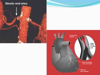 Stenotic renal arteryStenotic renal artery
 