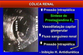 CÓLICA RENAL
       Pressão Intrapiélica
           Síntese de
        Prostaglandina E2

      Vasodilatação capilar
          glomerular
      Fluxo sanguíneo renal

       Pressão Intrapiélica

    - Inibição H. Antidiurética
 