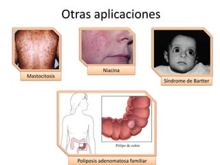 Otras aplicaciones

Niacina
Mastocitosis

Síndrome de Bartter

Poliposis adenomatosa familiar

 