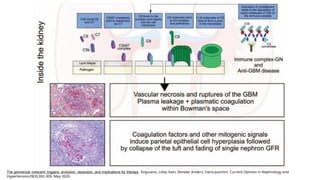 Comprehensive Overview of Anti-Glomerular Basement Membrane Disease ...