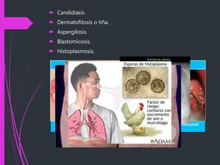 MUGUET EN ENCÍA Y
LABIO SUPERIOR
MUGUET EN LENGUA MUGUET EN PALADAR
 Candidiasis.
 Dermatofitosis o tiña.
 Aspergilosis.
 Blastomicosis.
 Histoplasmosis.
MUGUET ORAL
 