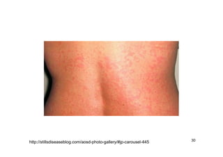 Asot Rash Antimicrobial stewardship(asp)and mdr | PDF