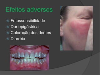 Efeitos adversos 
 Fotossensibilidade 
 Dor epigástrica 
 Coloração dos dentes 
 Diarréia 
 