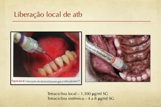 Liberação local de atb




          Tetraciclina local – 1.300 μg/ml SG
          Tetraciclina sistêmica – 4 a 8 μg/ml SG
 