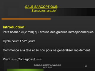 Introduction:
Petit acarien (0,2 mm) qui creuse des galeries intraépidermiques
Cycle court 17-21 jours
Commence à la tête et au cou pour se généraliser rapidement
Prurit +++;Contagiosité +++
GALE SARCOPTIQUE:
Sarcoptes scabiei
37
DR DIDOUH MOSTAFA COURS
IFCS 2012
 