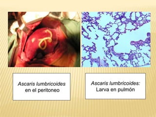 Ascaris lumbricoides   Ascaris lumbricoides:
  en el peritoneo        Larva en pulmón
 