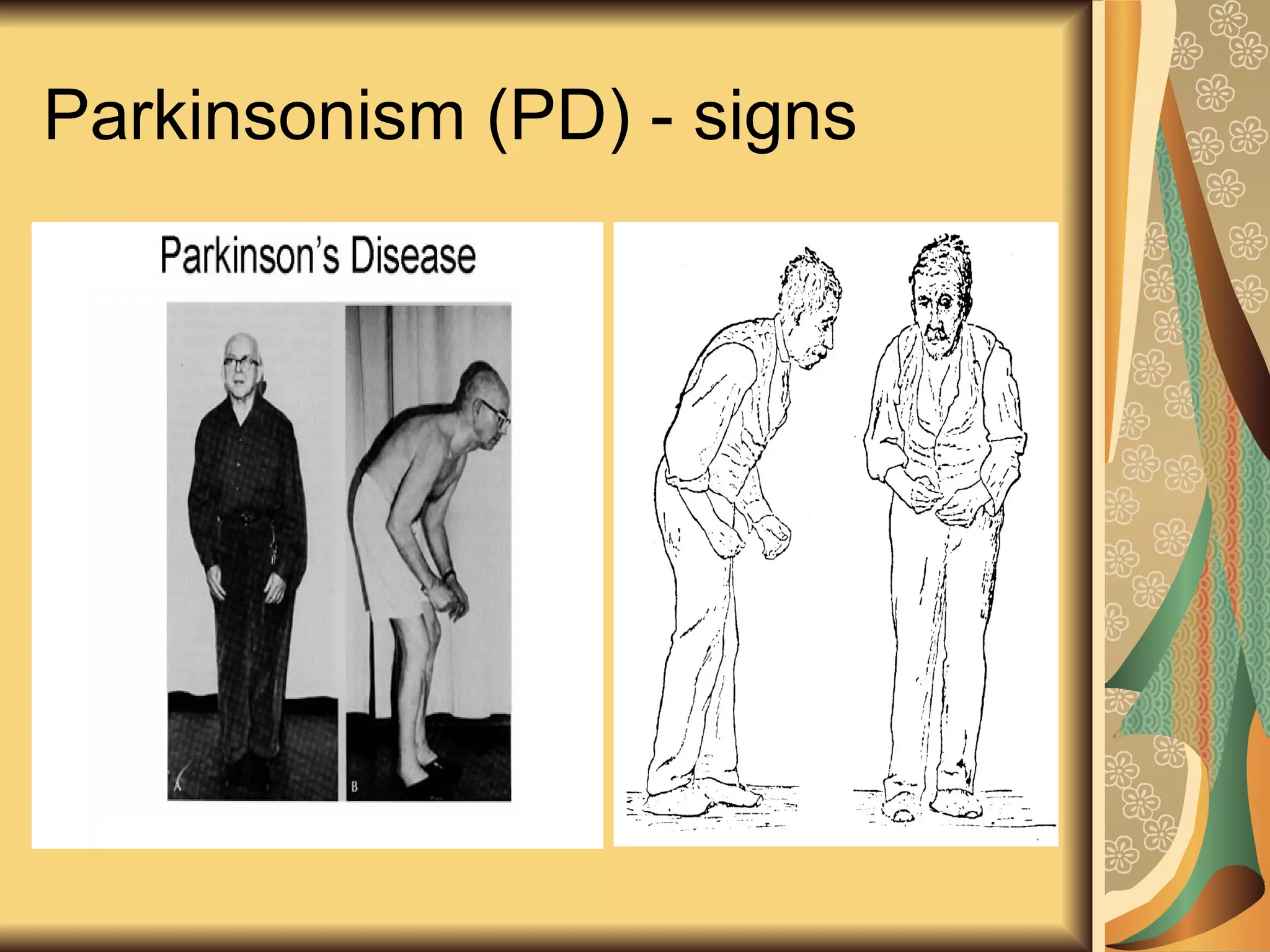 Parkinsonism (PD) - signs
 