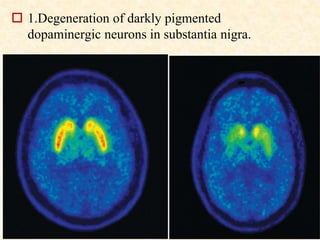  1.Degeneration of darkly pigmented
dopaminergic neurons in substantia nigra.
 