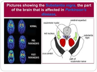 Pictures showing the Substantia nigra, the part of
the brain that is affected in Parkinson's disease.
 