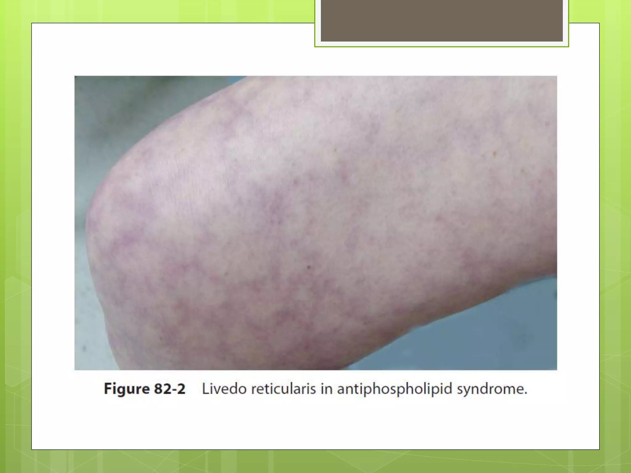 Antiphospholipid antibody syndrome | PPTX