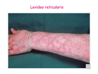 Levideo reticularis 
 