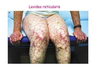 Levideo reticularis 
 
