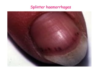 Splinter haemorrhages 
 