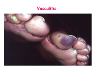 Vasculitis 
 