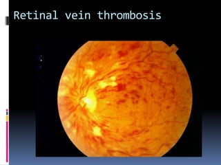Retinal vein thrombosis 
 