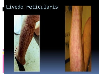 Livedo reticularis 
 