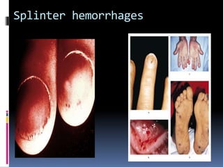 Splinter hemorrhages 
 