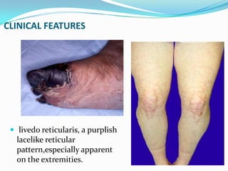 Antiphospholipid syndrome.pptx new | PPTX