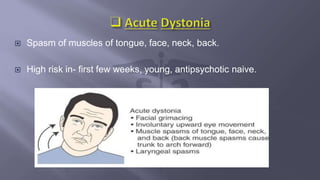  Spasm of muscles of tongue, face, neck, back.
 High risk in- first few weeks, young, antipsychotic naive.
 