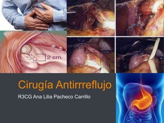 Cirugía Antirrreflujo
R3CG Ana Lilia Pacheco Carrillo
 