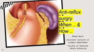Anti-reflux
surgry
When .. &
How ..
Ahmed Nassr
Assistant lecturer in
surgery department
Faculty of medicine
,Minia Univesity
 