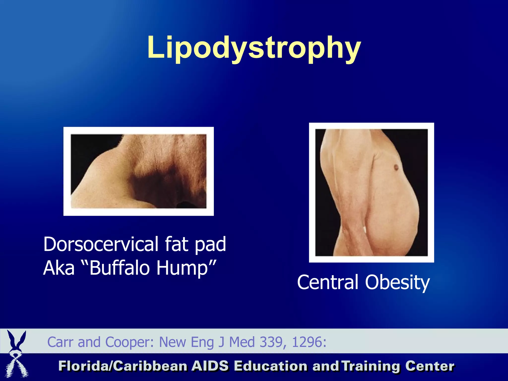 Lipodystrophy Dorsocervical fat pad Aka “Buffalo Hump” Central Obesity Carr and Cooper: New Eng J Med 339, 1296: 