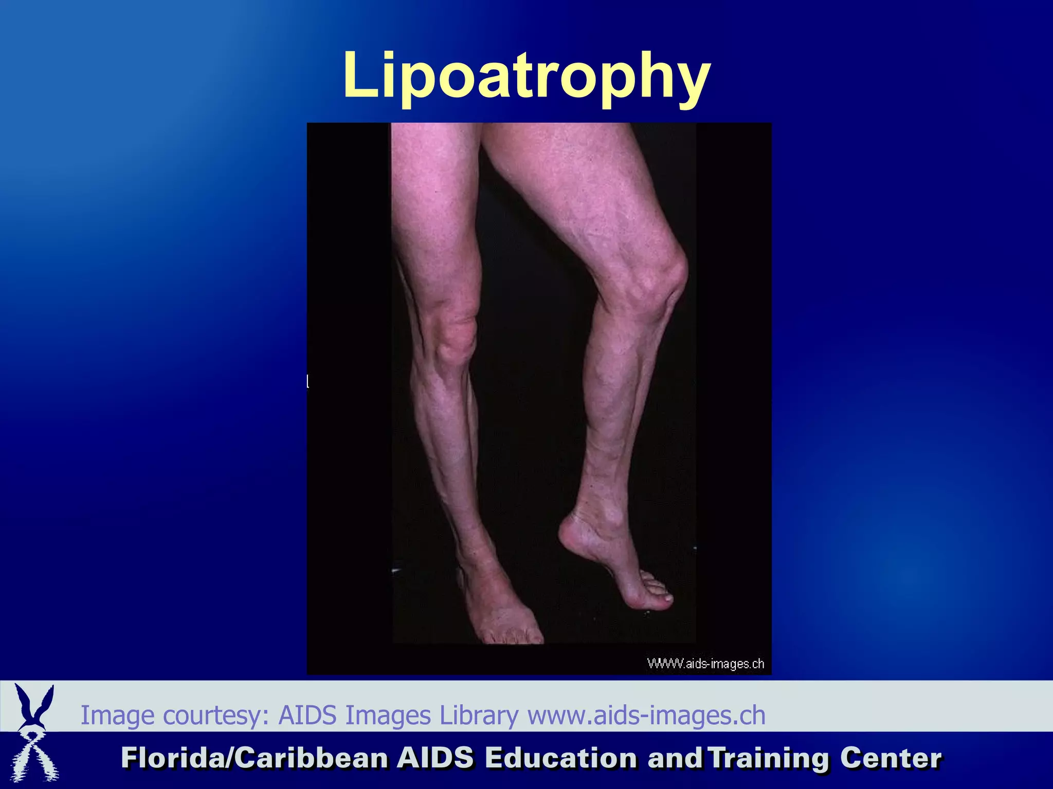 Lipoatrophy Image courtesy: AIDS Images Library www.aids-images.ch 