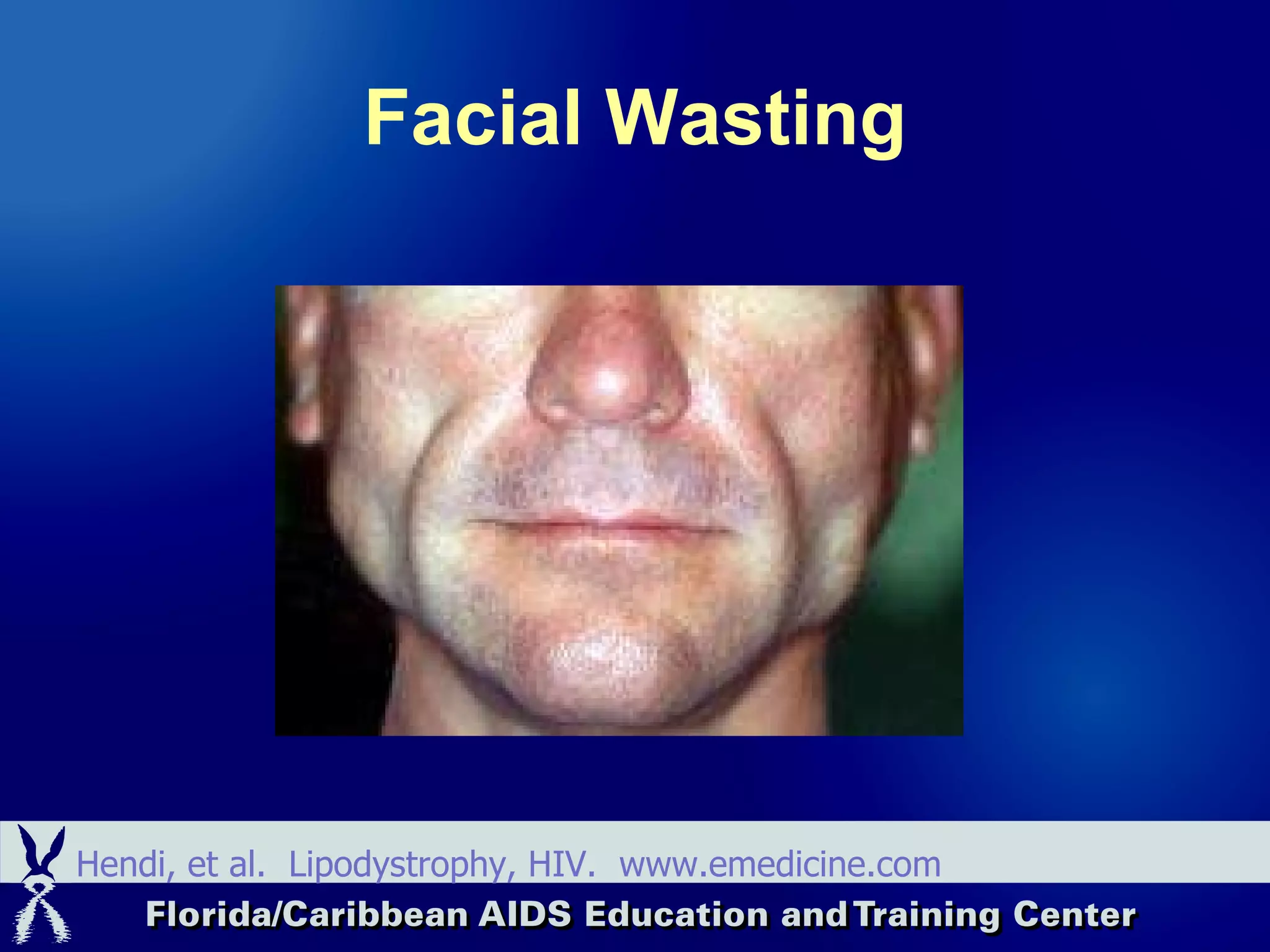 Facial Wasting Hendi, et al.  Lipodystrophy, HIV.  www.emedicine.com 