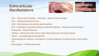 Extra-articular
Manifestations
• Skin – Rheumatoid nodules – vasculitis – splinter haemorrhages
• Eye -  keratoconjunctivitis sicca
• Oral - Oral dryness and salivary gland swelling
• GIT - mesenteric vasculitis leading to intestinal infarction – bleeding and perforation
• Pulmonary - Pleural effusions
• Cardiac - thickening of the artery walls (atherosclerosis) and heart attacks 
• Renal -  mesengial glomerulonephritis
• Haematological: anaemia, neutropenia, thrombocytopenia, thrombocytosis, eosinophilia
etc.
• Neurological – Peripheral neuritis
 