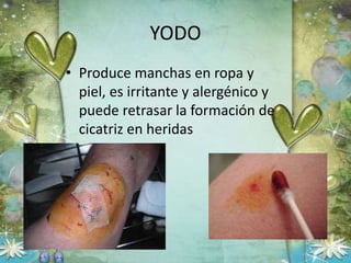 YODO
• Produce manchas en ropa y
piel, es irritante y alergénico y
puede retrasar la formación de
cicatriz en heridas
 