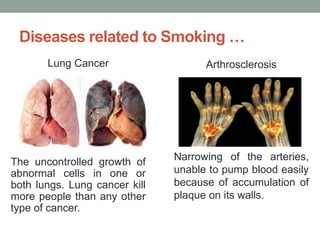 Diseases related to Smoking …
Lung Cancer
The uncontrolled growth of
abnormal cells in one or
both lungs. Lung cancer kill
more people than any other
type of cancer.
Arthrosclerosis
Narrowing of the arteries,
unable to pump blood easily
because of accumulation of
plaque on its walls.
 
