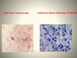 Anti tuberculous Drugs and Patient Counseling | PPTX