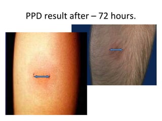 PPD result after – 72 hours.
 