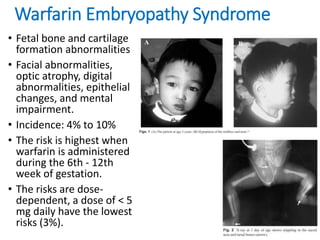 Warfarin Embryopathy Syndrome
• Fetal bone and cartilage
formation abnormalities
• Facial abnormalities,
optic atrophy, digital
abnormalities, epithelial
changes, and mental
impairment.
• Incidence: 4% to 10%
• The risk is highest when
warfarin is administered
during the 6th - 12th
week of gestation.
• The risks are dose-
dependent, a dose of < 5
mg daily have the lowest
risks (3%).
 