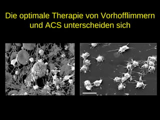 Die optimale Therapie von VorhofflimmernDie optimale Therapie von Vorhofflimmern
und ACS unterscheiden sichund ACS unterscheiden sich
 
