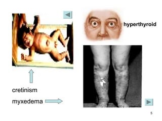 hyperthyroid




cretinism
myxedema
                     5
 
