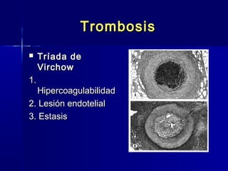 TTrroommbboossiiss 
 TTrrííaaddaa ddee 
VViirrcchhooww 
11.. 
HHiippeerrccooaagguullaabbiilliiddaadd 
22.. LLeessiióónn eennddootteelliiaall 
33.. EEssttaassiiss 
 