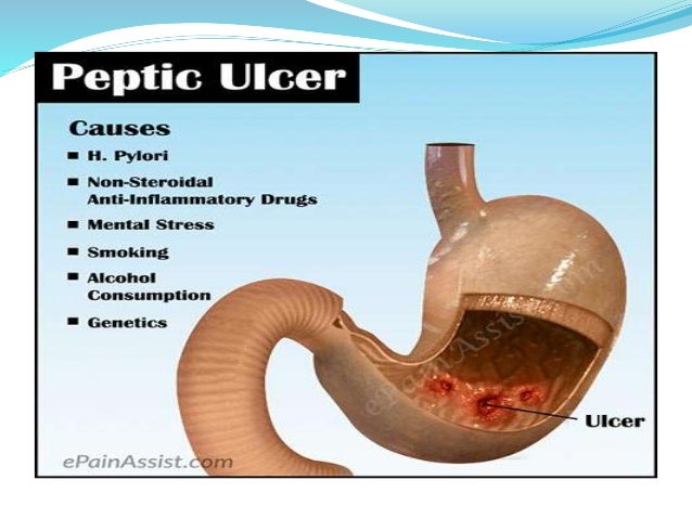 Antiulcer drugs