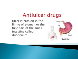 Ulcer is erosion in the
lining of stomch or the
first part of the small
intestine called
duodenum
 